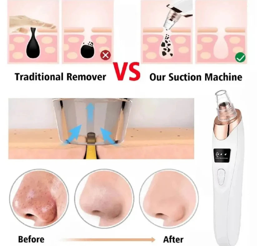 Deep Pore Cleaner Vacuum Blackhead Remover | Facial Pore Cleanser | Acne & Whitehead Removal Device